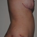 5 weeks post-op