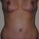 5 weeks post-op