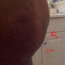 dent