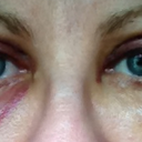 Day 3 Open. Under right eye very swollen and bruised. Bruising starting to appear under left eye.