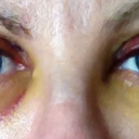 Day 4 Open. Bruising under right eye starting to yellow, still quite swollen. Under left eye never turned into a shiner - going straight to yellow.
