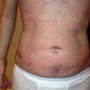 Day 3 post-op torso