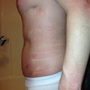 Day 3 post-op side (ignore my pneumothorax scar up top from when I was a premature baby)