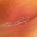 This is my scar with the scar guard on.. it does flake off which is kinda annoying.