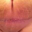 My scar after a shower..she have some scar guard on...I am sure it will all come off someday.