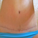 15 weeks, Scar.  A little discouraged with how prevalent the BB scar is.  The TT scar is healing better on the right than left.  Hmmmm.