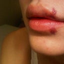 about 36 hrs after juvederm ultra plus