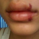 10/30/11. Almost 48 hrs after juvederm ultra plus