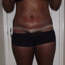 Day 15 seroma and swollen, not a nice combo...