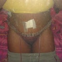 Days after surgery w/ stupid drain