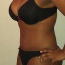 4 months Post op