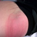right love handle after the device is taken off. red and bulging. went down in 5 seconds