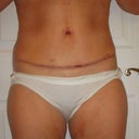 10 days post surgery - looks great, feel great!