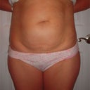 Before - lots of loose skin and hernia in belly button