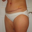 Also had inner thigh lipo, little brusing and swelling left