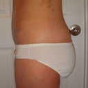 10 days post sugery, bruising from lipo, but feel great!