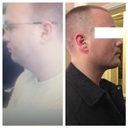 Final update. 8 months after. Lost some weight too since the other "after" photos were taken.