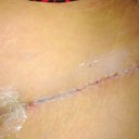 My scar at 17 days! no expensive creams (although I did buy one) but I turned to what I know...NEOSPORIN! and it works just great! :)