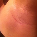 Incision 6 weeks