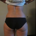 Pre Op horrid rear view pic