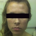 After 3 months of menocycline, chemical peels and microderms. This is what helped me, not accutane.
