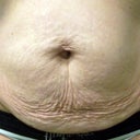 Before Tummy Tuck