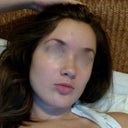 This is me BEFORE Retin-A, about 2 weeks ago, without makeup. Mostly clear with a couple stray pimples.