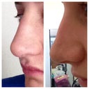 the left picture is right before I got hit and the right is the day after =/