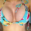 9 weeks post-op, no padding on bikini.. gotta love the roundness of lower pole :)