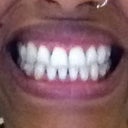 After Invisalign:  Note the crookedness is actually my smile, not the teeth.