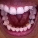 Lower jaw after Invisalign.  My lower jaw wasn't as bad, but I did have a cross-bite which no longer exists.