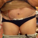 This is post op.  1 week.