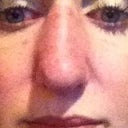 this is the swelling that occurred on the drive home after the cast was removed