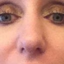todays picture - just a little over 2 weeks post op