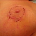 It is only 9 days. I think the incisions look great!