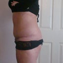11 weeks po, totally relaxed here so not holding in at all and I hate this pouch above my incision. This photo was taken about 5.30 pm so prob some swelling here.