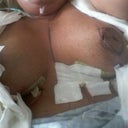 First after pic....5 hours post op
