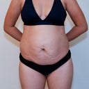 Before surgery