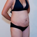 Before surgery