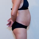Before surgery