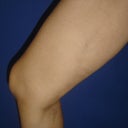 50 Year Old Man With Varicose Veins