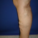 50 Year Old Man With Varicose Veins