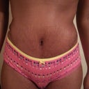 PO Day 15 This pic shows the swelling around my flanks. My pubis area is swollen too! :/ I think that there is fluid there too :