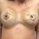 Post op!!