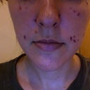 This is the 2nd day after my 2nd treatment.