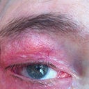 After Photo. Dr. Levine removed the buried lashes, but failed twice to close the corner juncture. Eye ends with recessed red tissue.