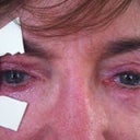 After Photo. Throbbing pain at open end corner necessitates viscous ointment 24/7 and frequent patching.