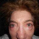 After Photo. Without my consent, Dr. Levine used lumpy fat graft strips from my stomach to create a new deformity of unequal under-eye pouches.