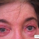 After Photo. Dr. Levine also added fat graft strips above my eyes. Note disastrous results: asymmetrical eyes and unequal amounts of fat to upper eye areas, resulting in wider space above left eye.