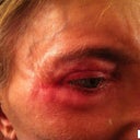 After Photo. No change to Before and After photos. Dents and scar-trough depressions never filled.